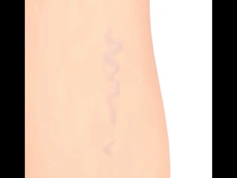 Veniselle, crema para várices, gel para várices, eliminar várices naturalmente, tratamiento para várices, várices en las piernas, mejorar la circulación en piernas, alivio para piernas cansadas, crema para arañitas vasculares, reducir inflamación en piernas, remedio natural para várices, crema para mejorar circulación, piernas sin várices, cómo eliminar várices, solución para venas varicosas.