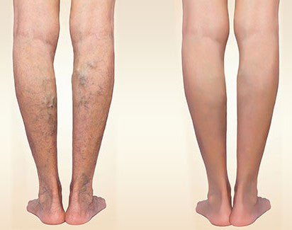Veniselle, crema para várices, gel para várices, eliminar várices naturalmente, tratamiento para várices, várices en las piernas, mejorar la circulación en piernas, alivio para piernas cansadas, crema para arañitas vasculares, reducir inflamación en piernas, remedio natural para várices, crema para mejorar circulación, piernas sin várices, cómo eliminar várices, solución para venas varicosas.