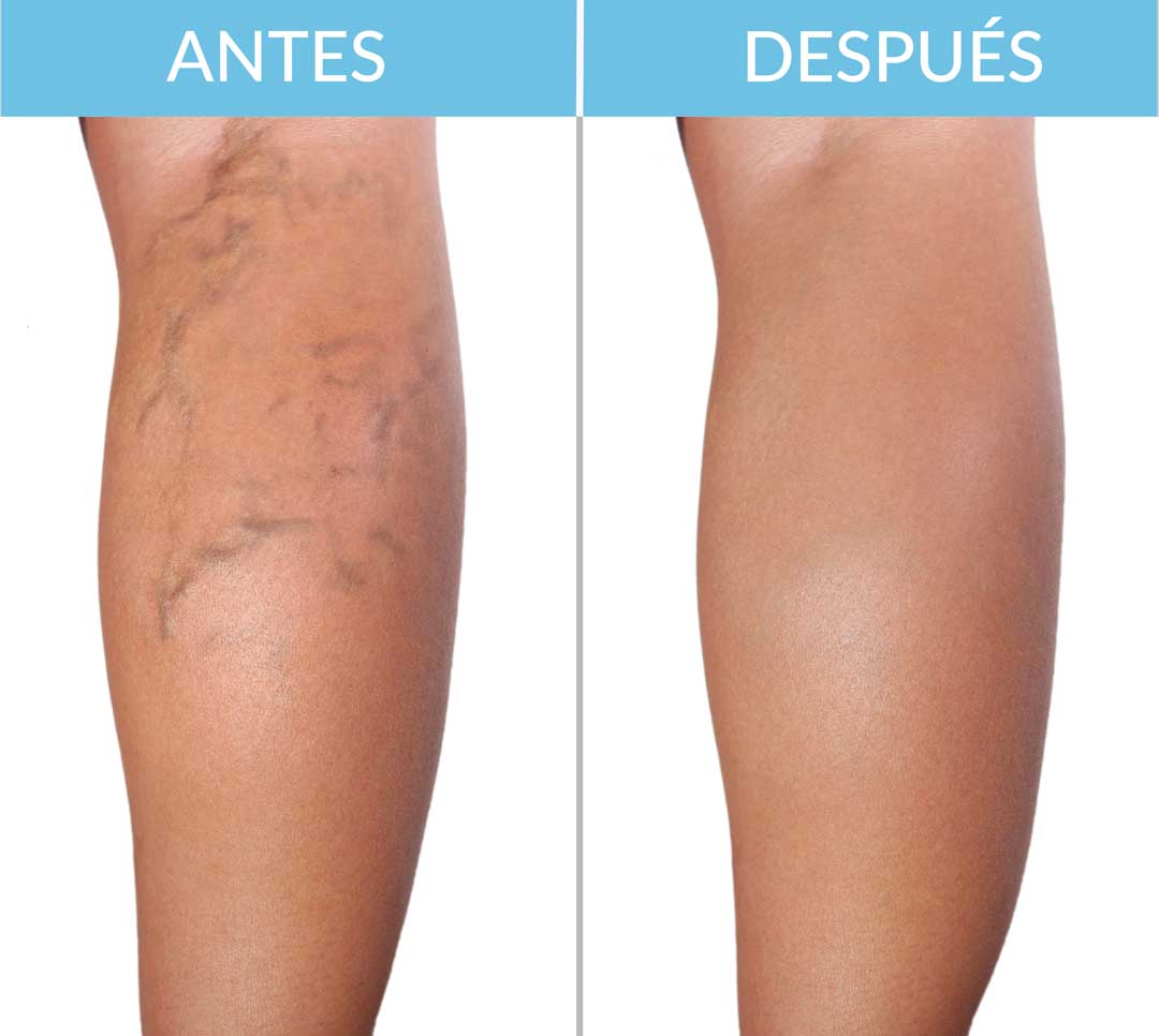 Veniselle, crema para várices, gel para várices, eliminar várices naturalmente, tratamiento para várices, várices en las piernas, mejorar la circulación en piernas, alivio para piernas cansadas, crema para arañitas vasculares, reducir inflamación en piernas, remedio natural para várices, crema para mejorar circulación, piernas sin várices, cómo eliminar várices, solución para venas varicosas.